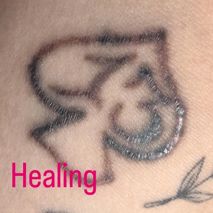healing after laser